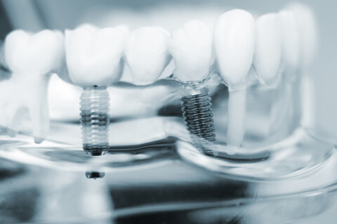 歯のインプラント治療とは